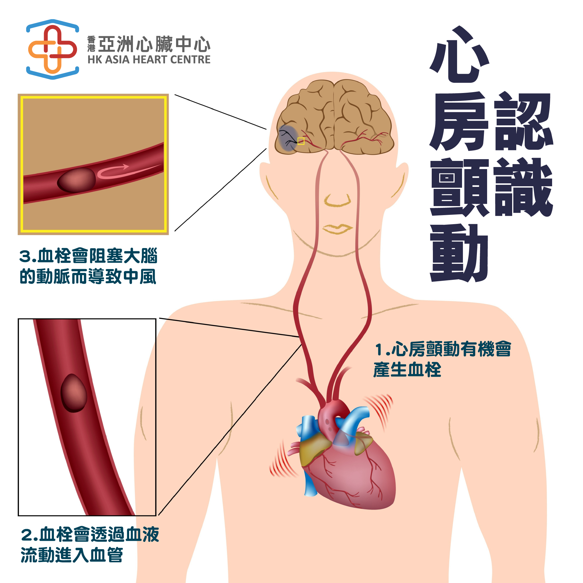 【認識心房顫動】