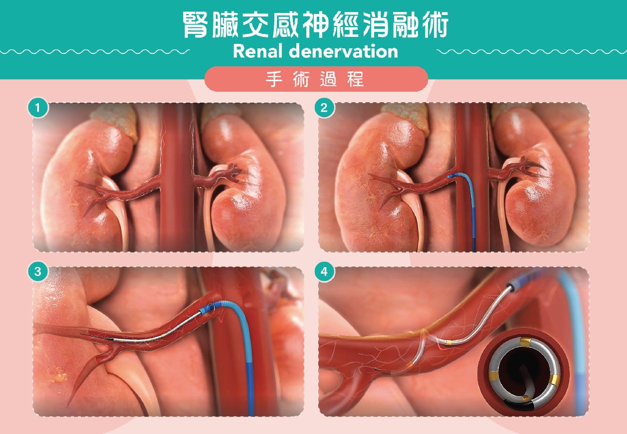 【新微創手術助控頑固高血壓】