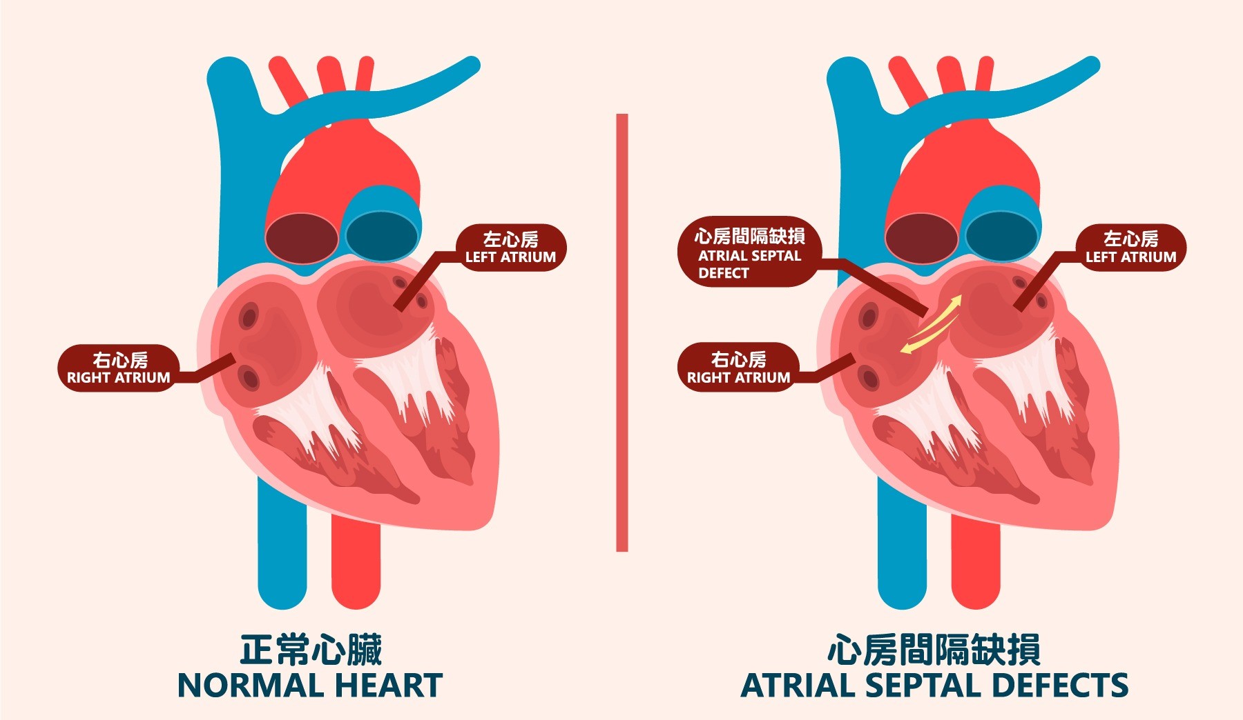 心房間隔缺損