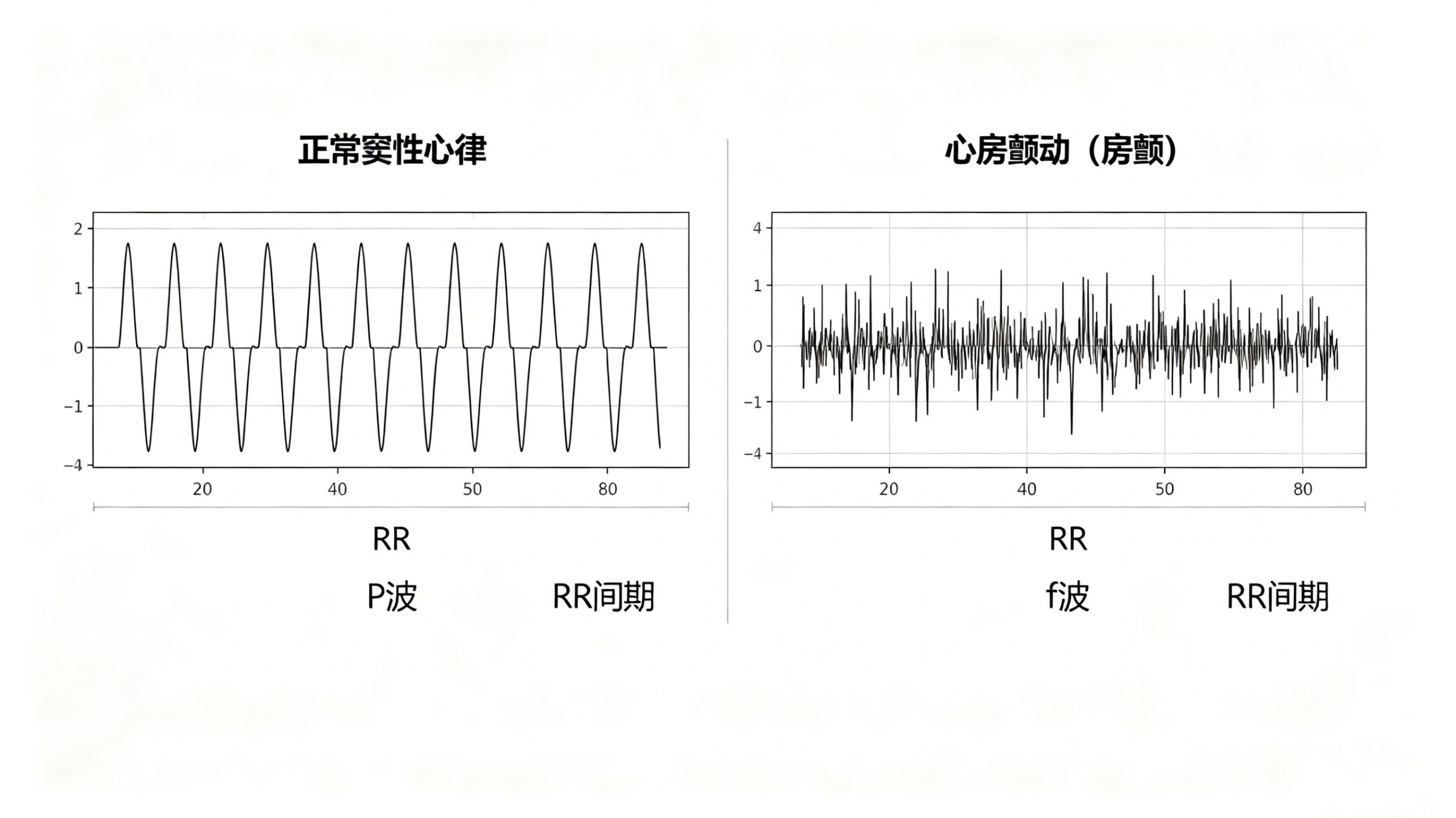 心房颤动 (房颤)